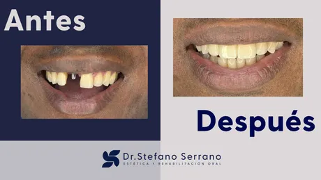 Rehabilitación Dental Integral